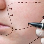 Combien coûte chirurgie esthétique pommettes des joues ?