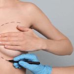 Combien coûte une implantation mammaire ? 